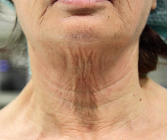 Ultraformer voor foto